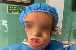 جراحی کم‌سابقه پزشکان ایرانی برای نجات کودک سرطانی