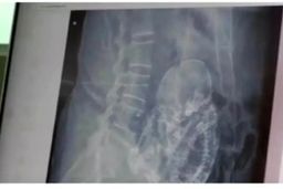 جنین مرده،علت دردهای مزمن زن ۸۴ ساله بعد از ۴۰ سال  + تصویر