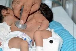 عمل جراحی برای جداکردن دوقلوهای به‌هم‌چسبیده شیرازی
