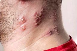 برای آبله مرغان چی بخوریم