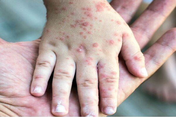 سرخک چرا بر سر زبان‌ها افتاده؟