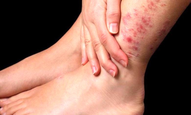 آیا کم‌خونی می‌تواند باعث جوش یا بثورات پوستی شود؟