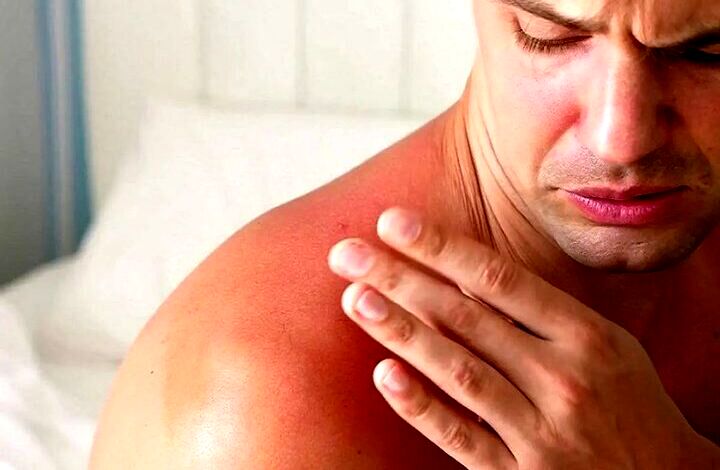 هشدار؛ مراقب سوختگی‌های پنهان آفتاب باشید