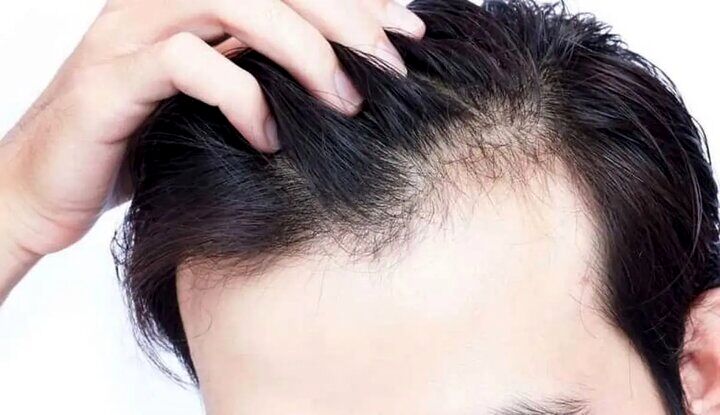 اختلال در این اندام‌های بدن سبب ریزش موی سر می‌شود