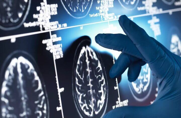 یک داروی گیاهی مفید علیه آلزایمر