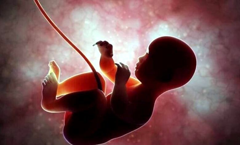 بیانیه وزارت بهداشت درباره سقط جنین مبتلا به سندروم داون