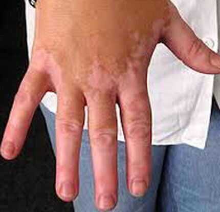 توصیه‌های مهم درباره این بیماری پوستی