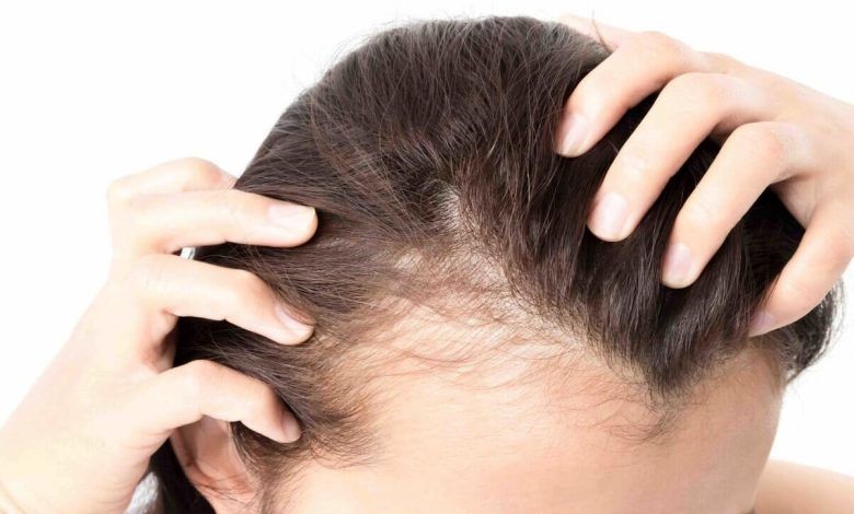 چهار توصیه مهم برای کسانی که ریزش مو دارند